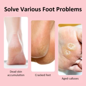 CallusClear Pro Electric Foot Callus Remover